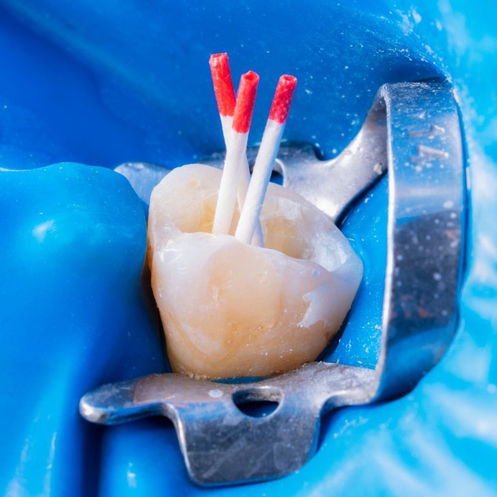 Root Canal Treatment