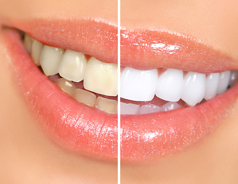 Teeth Whitening